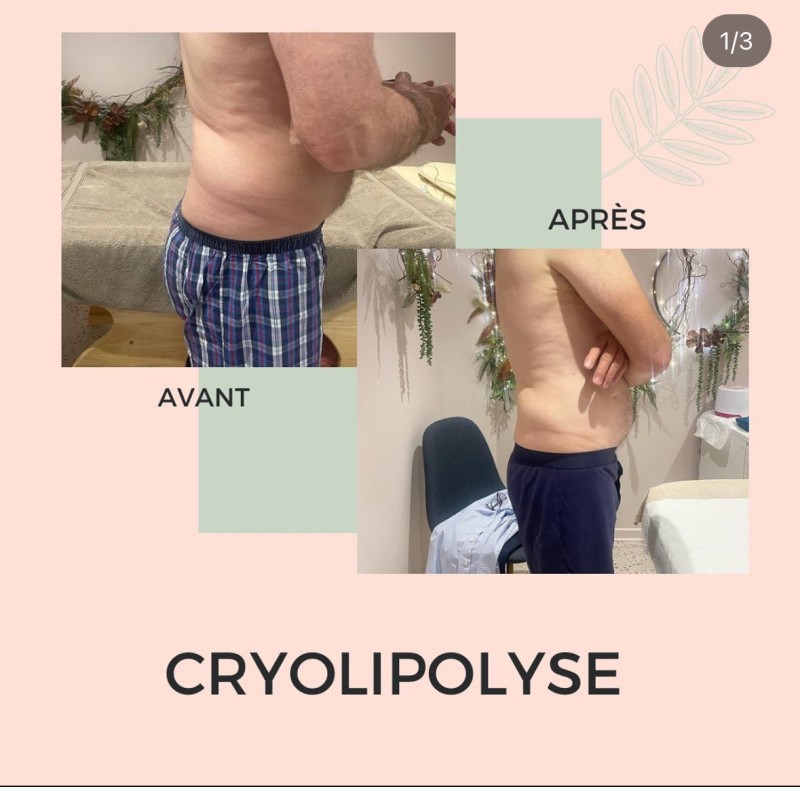 cryolipolyse 