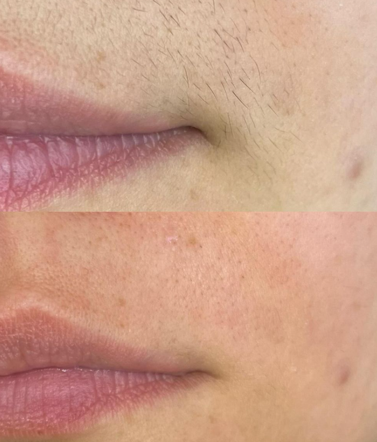 Résultats d'une épilation définitive visage par electrolyse après plusieurs séances