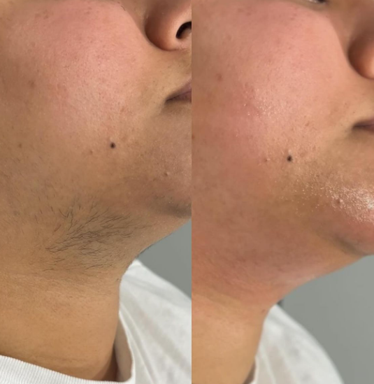 Comment se débarrasser des poils sur les joues et le menton à Lyon en institut