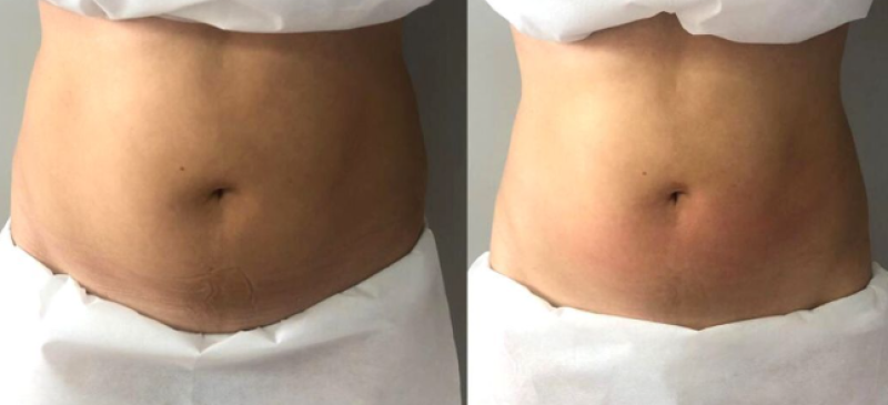 avant/après drainage lymphatique Renata França