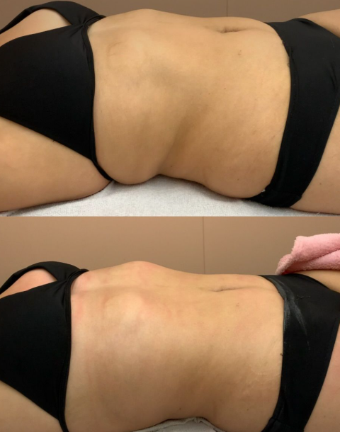 avant/après drainage lymphatique Renata França