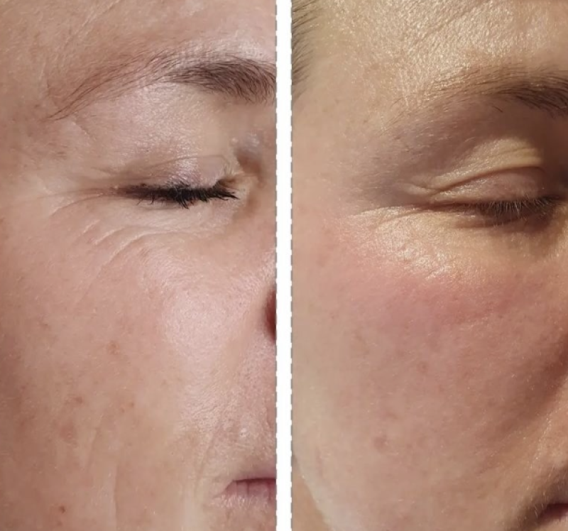 avant/après cure soin anti-age