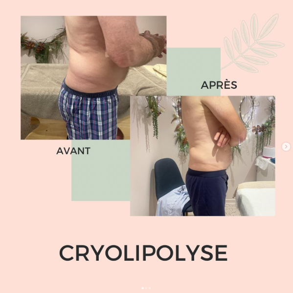 Séance de cryolipolyse pour perdre du gras sans douleur par le froid dans un institut spécialisé à Lyon 6