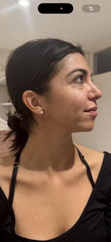 Avant/ après d’un super miracle face de la méthode Renata Franca pour raffermir le visage à Lyon 6