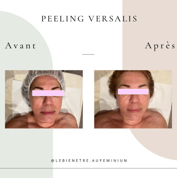 Peeling Versalis : soin anti-âge pour lisser les rides et diminuer les cicatrices à Lyon 6
